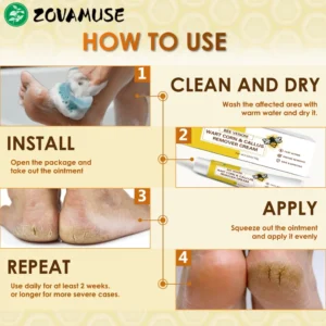 ZOVAMUSE Bee Venom Wart Corn & Callus Remover Cream