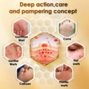 ZOVAMUSE Bee Venom Wart Corn & Callus Remover Cream
